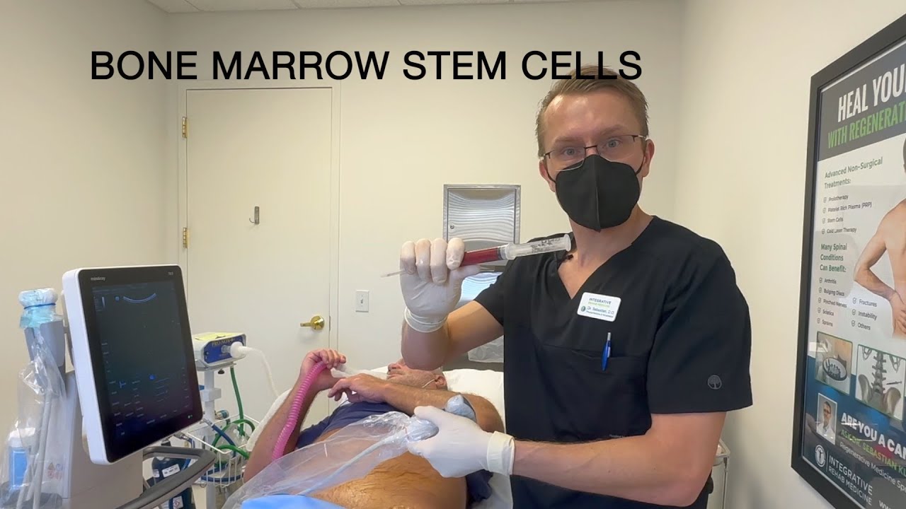 Hip Arthritis Treatment With Bone Marrow Stem Cells