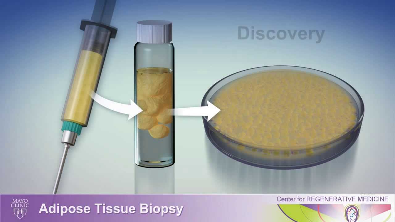 Stem cells for treatment of ALS at Mayo Clinic